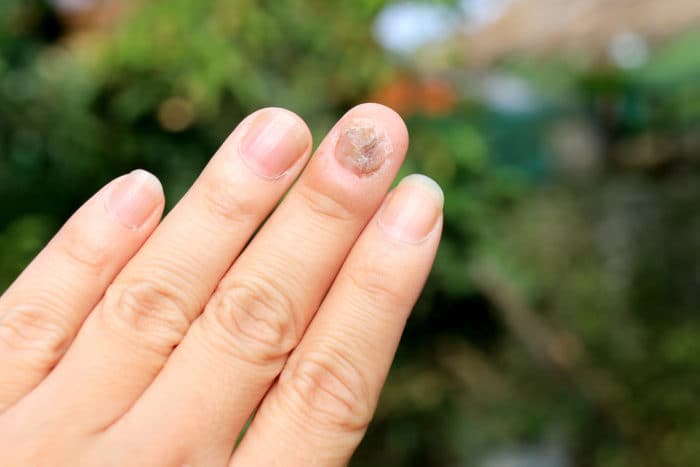 真菌感染了指甲