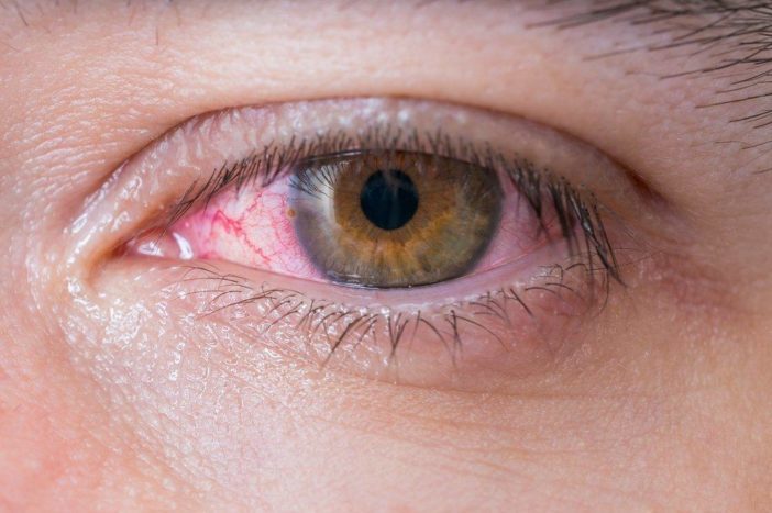 过敏性红眼结膜炎