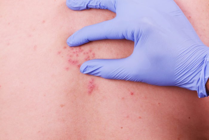 什么是带状疱疹？水痘或天花蛇疼