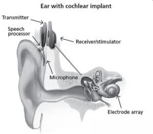 人工耳蜗植入装置