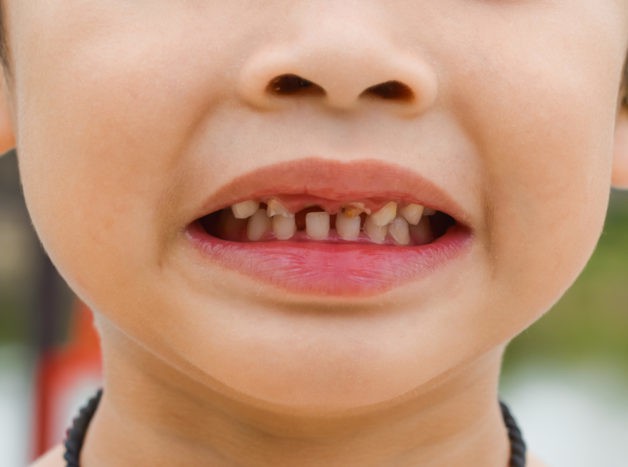 对孩子的牙齿造成伤害
