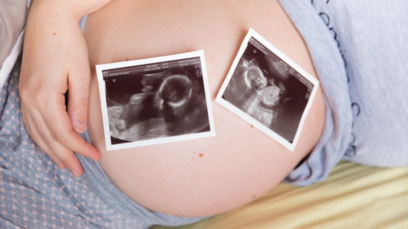 双胞胎怀孕的风险消失了